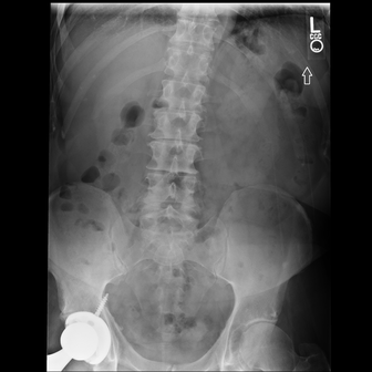 Lumbar spine radiograph, AP view