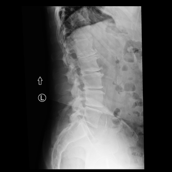 Lumbar spine radiograph, Lateral view